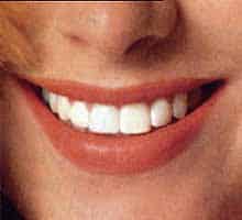 teeth whitening